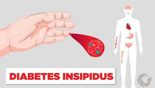 Mengenal Diabetes Insipidus dan Perbedaannya dengan Diabetes Melitus