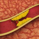 Berbagai Penyakit Akibat Kolesterol Tinggi, Waspadalah
