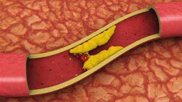 Berbagai Penyakit Akibat Kolesterol Tinggi, Waspadalah