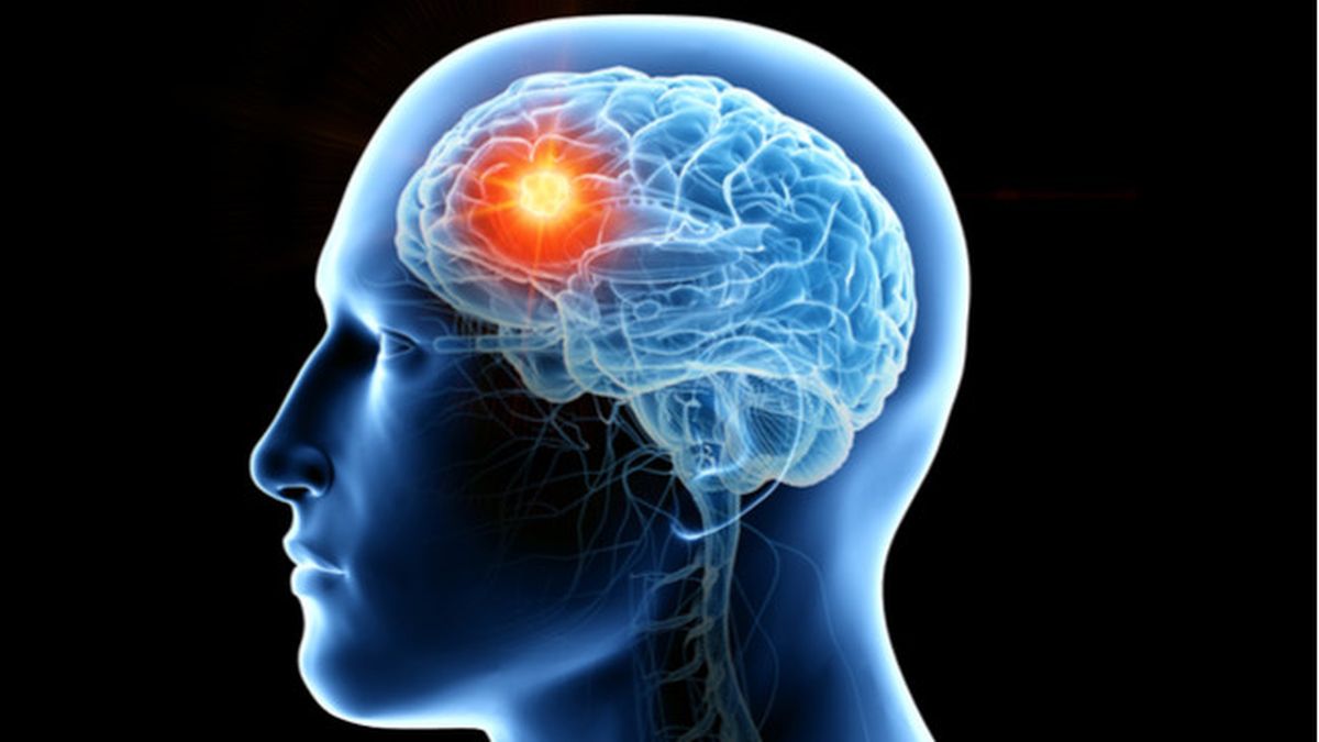 Inilah 5 Gejala Awal Tumor Otak yang Harus Diwaspadai